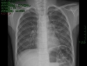 肺炎（Pneumonia）