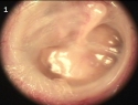 中耳積水的耳膜圖像