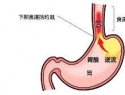 胃食道逆流