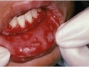 疱疹性口腔炎(herpetic gingivostomatitis)