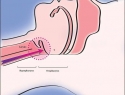 喉頭咽喉的胃酸逆流